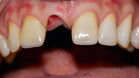 周公解梦梦见掉牙齿是什么意思 周公解梦梦见掉牙齿是什么意思