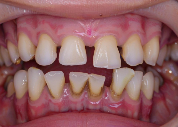 梦见牙齿松动 梦见牙齿松动