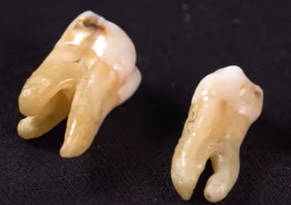 周公解梦梦见掉牙齿是什么意思  周公解梦梦见掉牙齿是什么意思