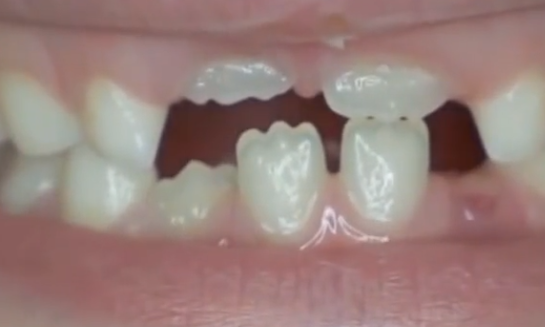 梦见牙掉了是什么意思 梦见牙掉了是什么意思