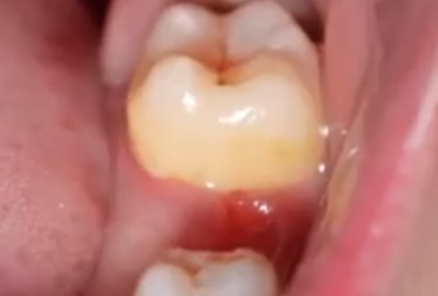 梦到牙齿掉了是什么意思 梦到牙齿掉了是什么意思