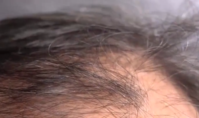 梦见掉头发 梦见掉头发