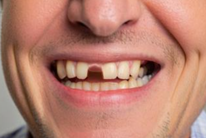 梦见掉牙齿是什么征兆 梦见掉牙齿是什么征兆